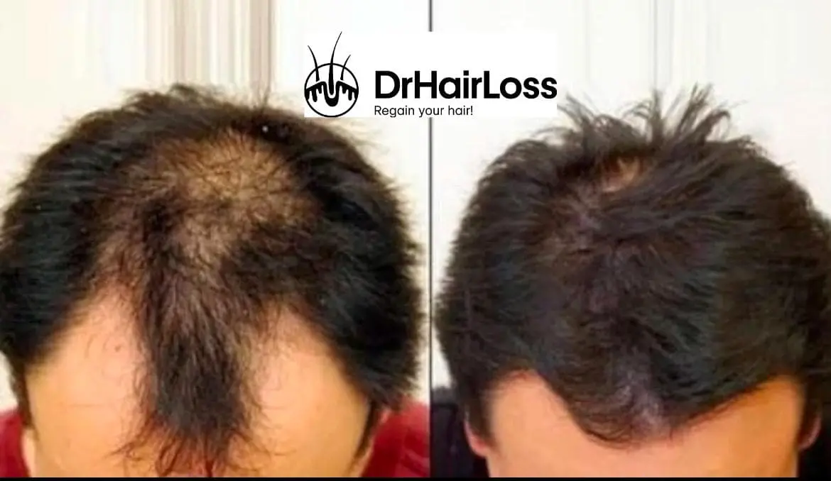 Hair restoration before and after results